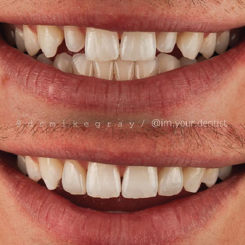 Mike Gray Before and after 3