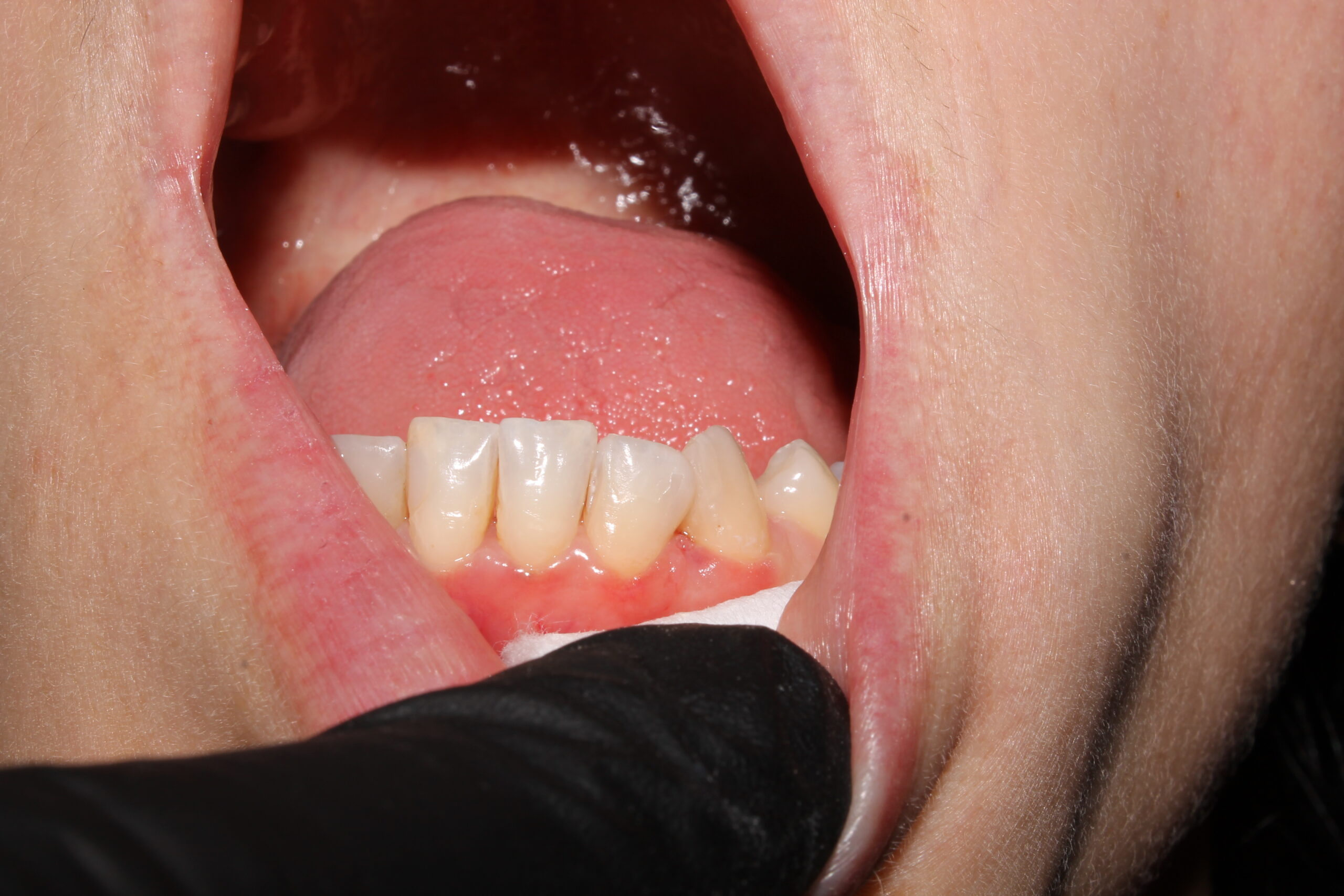 Periodontics Parkway Clinic Dental Fillings - Parkway Clinic Swansea