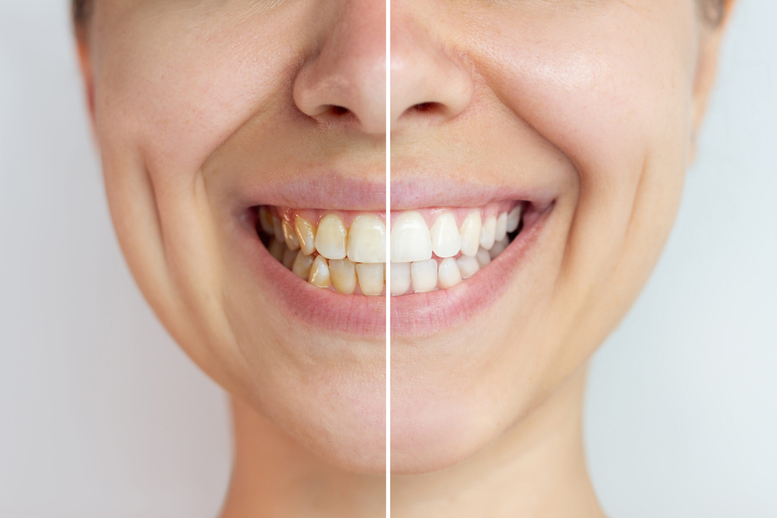 Teeth Whitening Quick Menu Parkway Clinic 2024 Teeth Whitening Quick Menu Parkway Clinic 2024