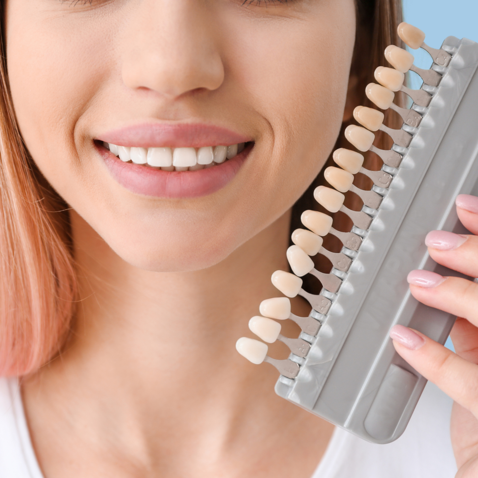 Composite Bonding Veneers Parkway Clinic Swansea 2