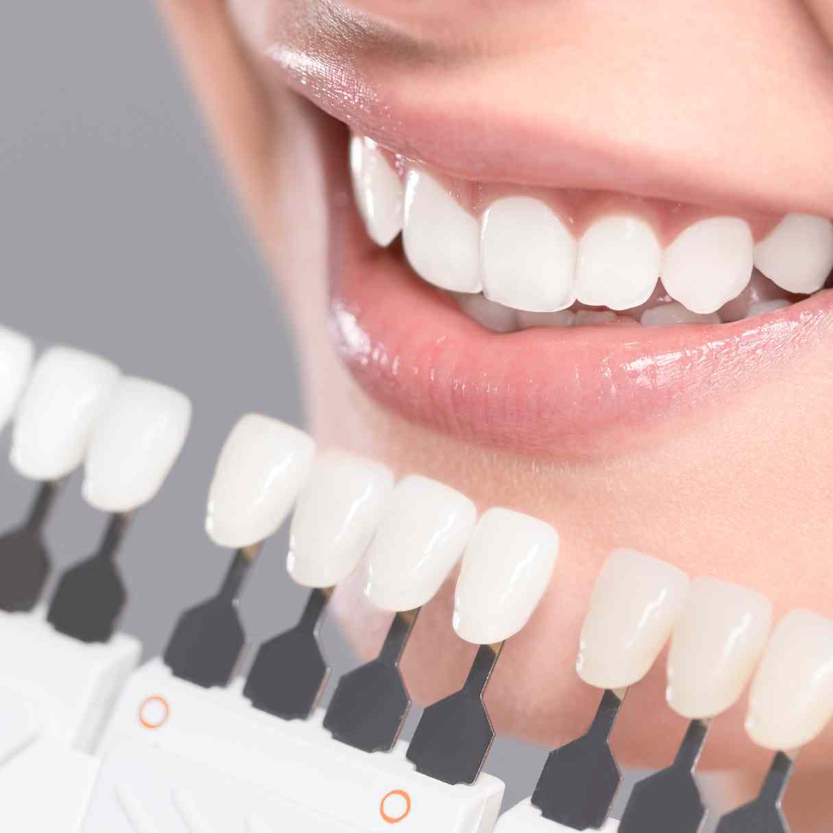 porcelain veneers parkway clinic swansea 2