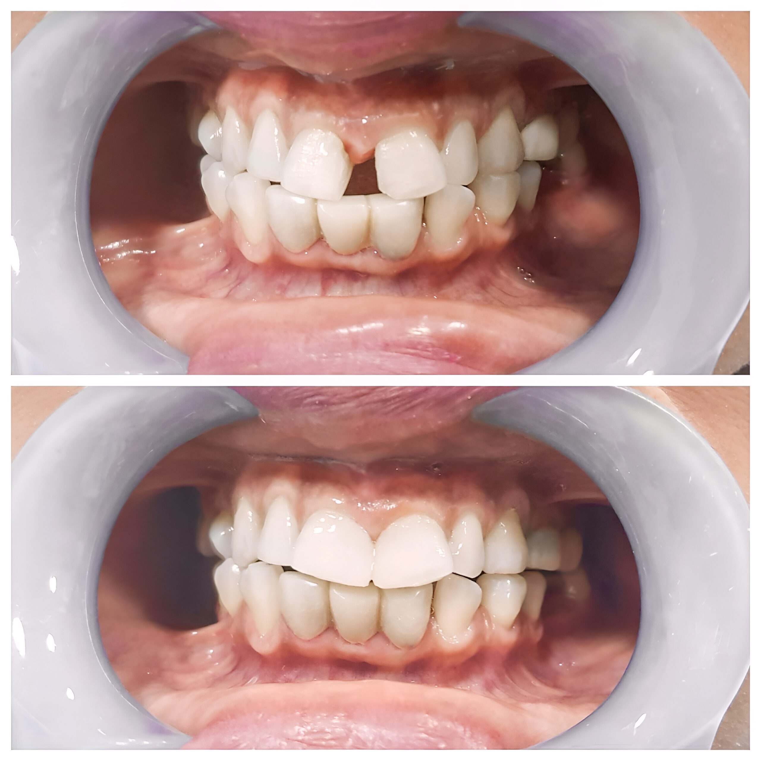 porcelain veneers parkway clinic swansea 4